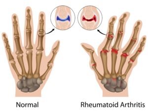 Therapy for Rheumatoid Arthritis in the Hand