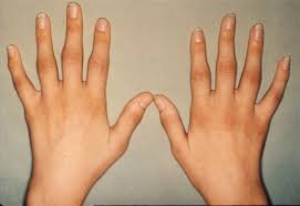 Hand Rheumatoid Arthritis Signs and Symptoms